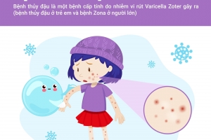 Bệnh thủy đậu và những điều cần biết