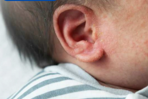 Rôm sảy ở trẻ nhỏ: Đừng nhầm với bệnh ngoài da khác
