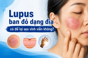 Lupus ban đỏ dạng đĩa có để lại sẹo không? Nguyên nhân và cách phòng ngừa