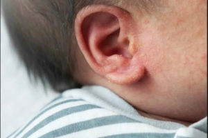 Rôm sảy ở trẻ nhỏ: Cha mẹ nên xử lý cho bé ra sao?