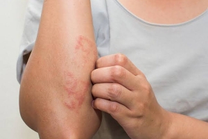 Cảnh giác trước 4 kiểu ngứa da bất thường cảnh báo nguy cơ bệnh lý ác tính
