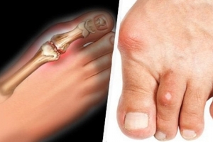 Những tín hiệu cảnh báo nồng độ axit uric cao trong máu thường bị bỏ qua