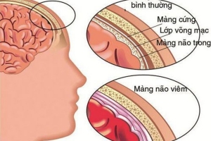 Cảnh giác nguy cơ tử vong nhanh do não mô cầu sau chùm ca bệnh tại trường học