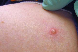 Ca nghi mắc bệnh đậu mùa khỉ tại tỉnh Đắk Lắk đã có kết quả âm tính