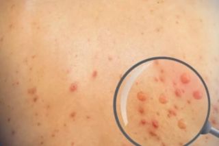 Tiền Giang phát hiện ca đậu mùa khỉ đầu tiên là một người làm vườn