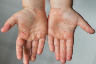 Lào Cai tăng cường phòng, chống bệnh tay chân miệng và các bệnh truyền nhiễm