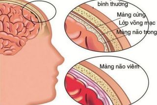 Cảnh giác nguy cơ tử vong nhanh do não mô cầu sau chùm ca bệnh tại trường học