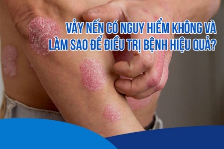 Vảy nến có nguy hiểm không và làm sao để điều trị bệnh hiệu quả?