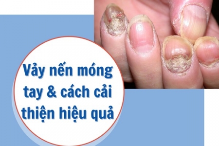 Vảy nến móng tay và cách cải thiện nhờ Kim Miễn Khang & Explaq