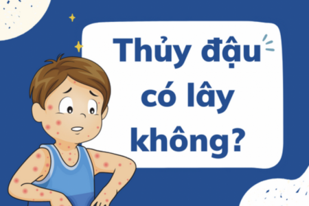 Thủy đậu có lây không và giải pháp từ bộ đôi gel & cốm Subạc
