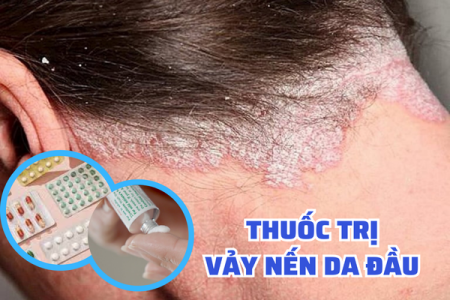 Tổng hợp các loại thuốc trị vảy nến da đầu và giải pháp từ Kim Miễn Khang