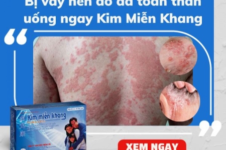 Tìm hiểu bệnh vảy nến đỏ da toàn thân và giải pháp từ Kim Miễn Khang