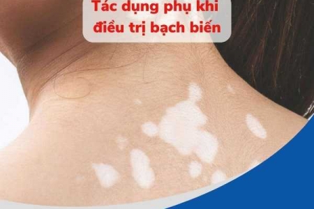 Tác dụng phụ khi điều trị bạch biến và giải pháp an toàn từ Kim Miễn Khang