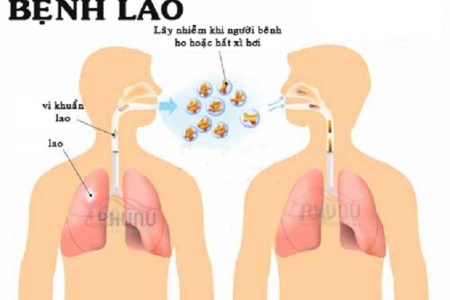 Khoảng 13.000 người tử vong/năm và nhiều người mắc bệnh Lao trong cộng đồng chưa được phát hiện