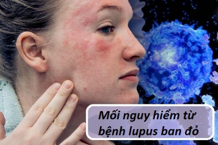 Mối nguy hiểm từ bệnh lupus ban đỏ và giải pháp từ sản phẩm Kim Miễn Khang