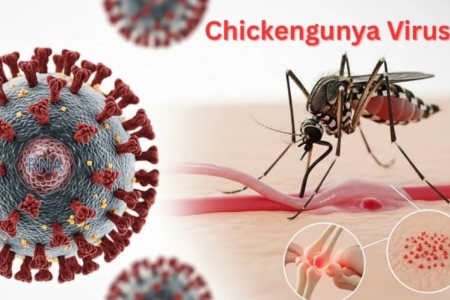 Bệnh Chikungunya dễ bị nhầm lẫn với bệnh khác