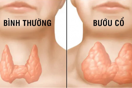 Bướu cổ lành tính có cần mổ không? Cách nhận biết và xử lý an toàn