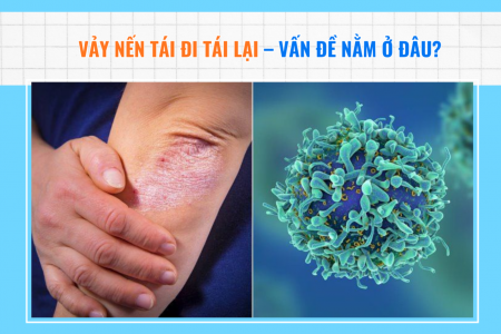 Vảy nến tái đi tái lại - Vấn đề nằm ở đâu?