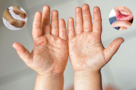 Tay chân miệng tăng nhanh, Bộ Y tế kiểm tra khẩn tại TP. HCM