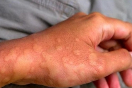 Áp lực cuộc sống kéo dài: Nguyên nhân khiến cơ thể dễ nổi mề đay, mẩn ngứa