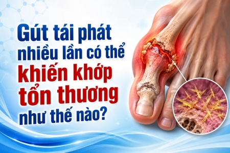 Gút tái phát nhiều lần có thể khiến khớp tổn thương như thế nào?