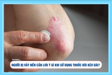 Người bị vảy nến cần lưu ý gì khi sử dụng thuốc bôi kéo dài?