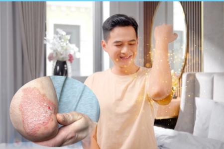 Cách giúp giảm viêm ngứa và kiểm soát bệnh vảy nến lâu dài!