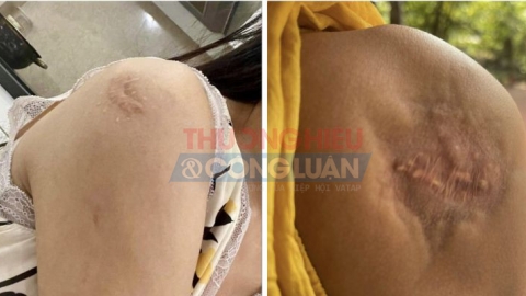 Hải Phòng: Đề xuất xử phạt 40 đến 50 triệu đồng đối với cơ sở tiêm sẹo lồi gây tổn thương cơ thể