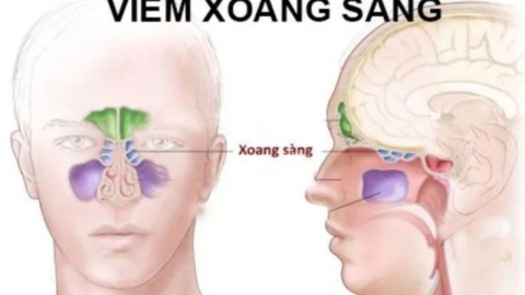 Cải thiện viêm xoang sàng hiệu quả tại nhà nhờ Xịt mũi họng Khiết Thanh