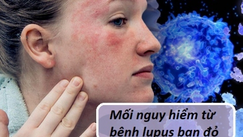 Mối nguy hiểm từ bệnh lupus ban đỏ và giải pháp từ sản phẩm Kim Miễn Khang