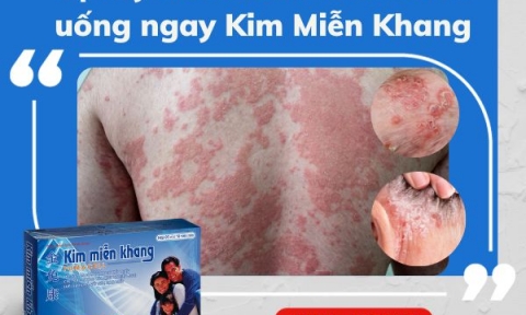 Tìm hiểu bệnh vảy nến đỏ da toàn thân và giải pháp từ Kim Miễn Khang