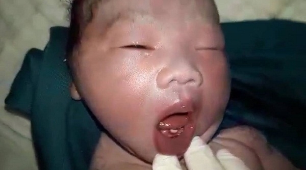 Hà Tĩnh: Kỳ lạ bé trai vừa sinh đã có răng ở hàm dưới