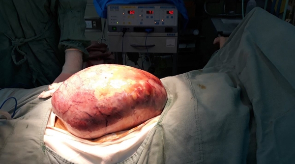 BV TƯ Huế: Phẩu thuật thành công khối u buồng trứng khổng lồ trong bụng cô gái trẻ