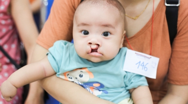 Hàng trăm trẻ được phẩu thuật nụ cười miễn phí