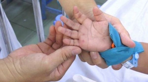Quảng Ngãi: Sốt xuất huyết và tay chân miệng bùng phát mạnh