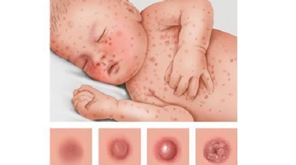 Xử lý các bệnh ngoài da do virus thường gặp như thế nào?