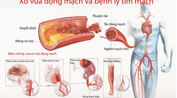 Máu nhiễm mỡ: Nguyên nhân, dấu hiệu và giải pháp hỗ trợ tốt cho bệnh