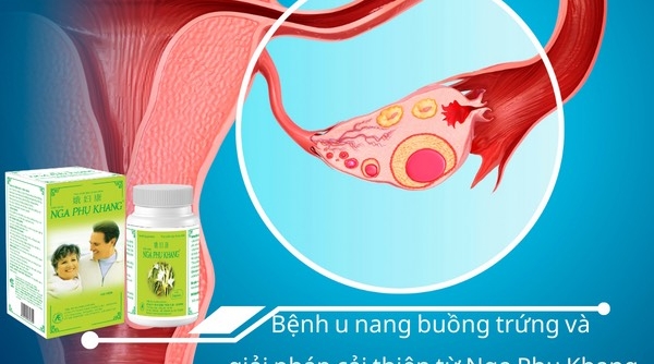 Bệnh u nang buồng trứng và giải pháp cải thiện từ Nga Phụ Khang