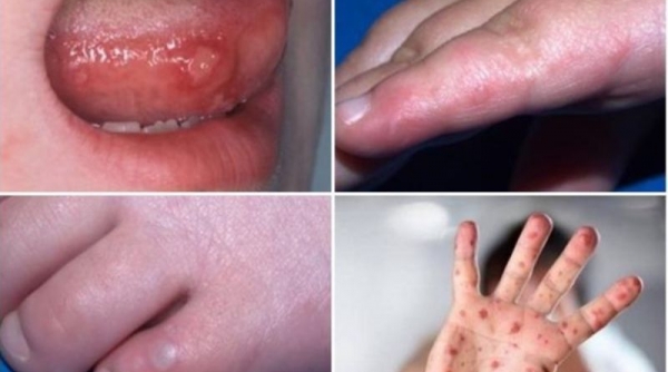 Khuyến cáo chủng virus EV71 gây bệnh tay chân miệng chuyển biến khó lường