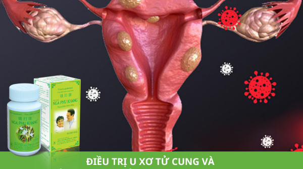 Tổng hợp cách điều trị u xơ tử cung và giải pháp cải thiện nhờ Nga Phụ Khang