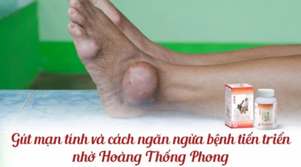 Gút mạn tính và cách ngăn ngừa bệnh tiến triển nhờ Hoàng Thống Phong