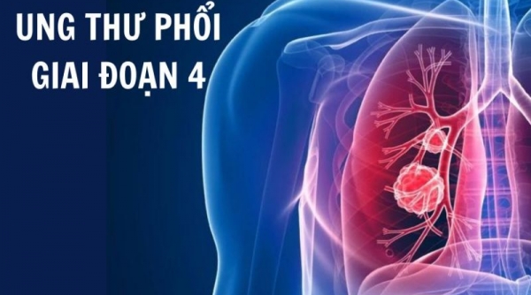 Tìm hiểu về ung thư phổi giai đoạn 4 và giải pháp thảo dược từ Tumolung