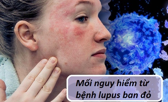 Mối nguy hiểm từ bệnh lupus ban đỏ và giải pháp từ sản phẩm Kim Miễn Khang