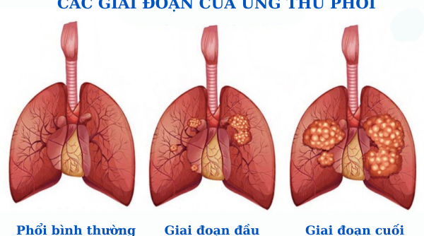 Ung thư phổi giai đoạn 1 và giải pháp ngăn chặn nhờ Tumolung