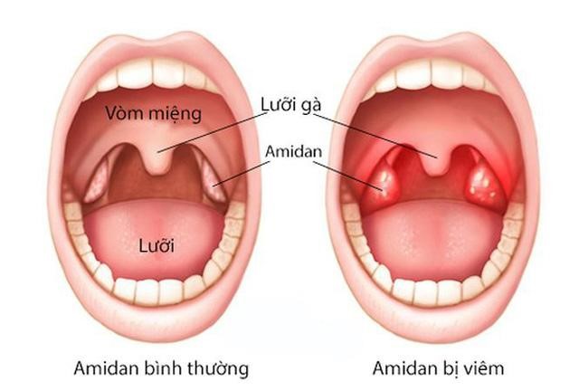 Viêm amidan là bệnh lý phổ biến ở mọi lứa tuổi