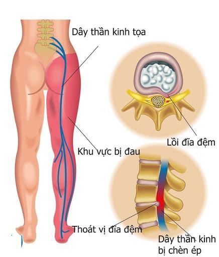 Thoát vị đĩa đệm gây đau buốt từ thắt lưng xuống chân