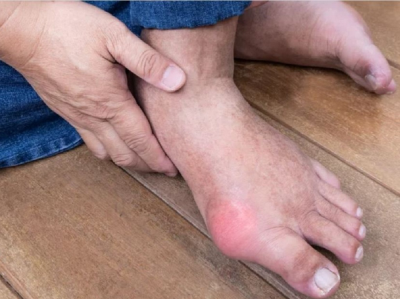 Cơn gout cấp gây đau nhức khớp dữ dội, hạn chế vận động, đi lại