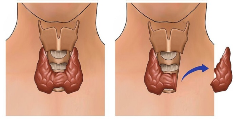 Phẫu thuật bướu cổ tiềm ẩn nhiều biến chứng nguy hiểm