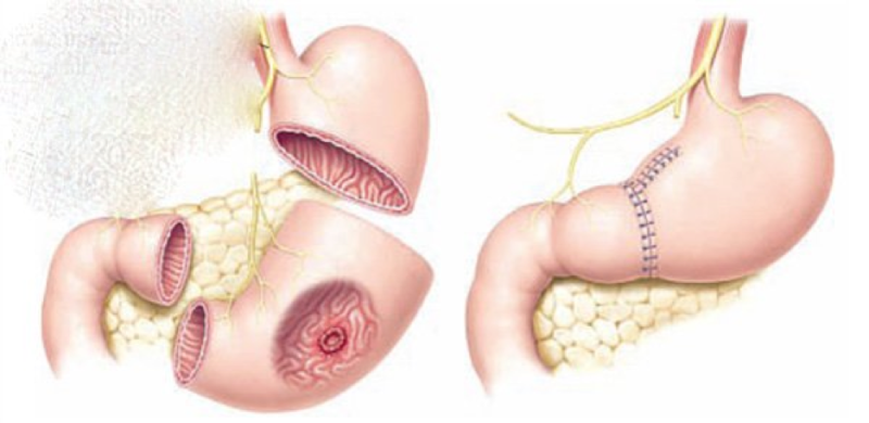 Phẫu thuật là phương pháp thường áp dụng cho ung thư dạ dày giai đoạn sớm