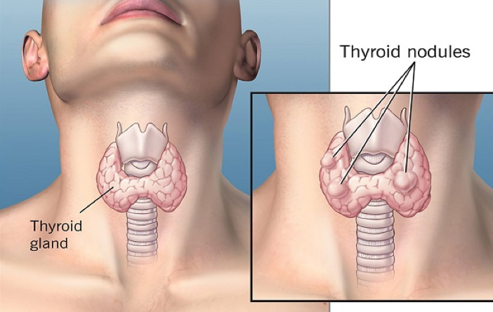 Phình giáp đa hạt là tình trạng tuyến giáp xuất hiện nhiều nhân giáp bên trong
